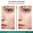 Kit Extrator de Cravos e Espinhas em Aço Inoxidável para Cuidados com a Pele do Rosto